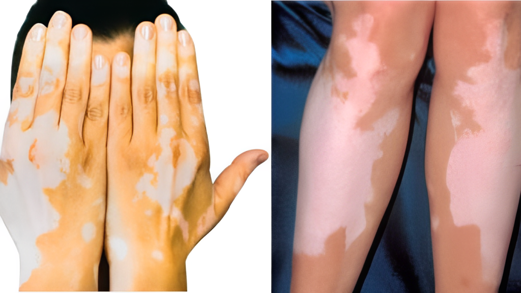 Vitiligo causes your skin to lose color or pigmentation.