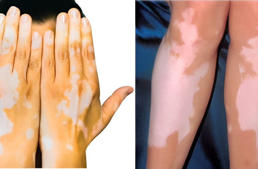 Vitiligo causes your skin to lose color or pigmentation.