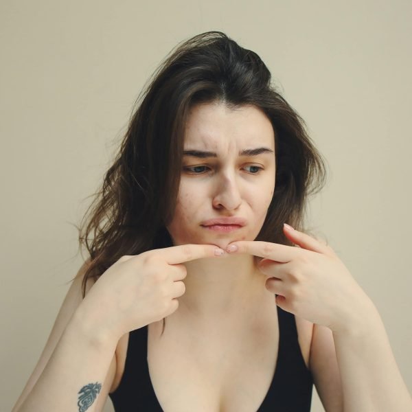 Get rid of acne forever.