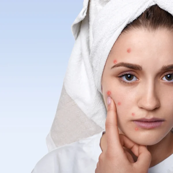 pimple , acne | Woman with towel on head pointing at pimples on her face.