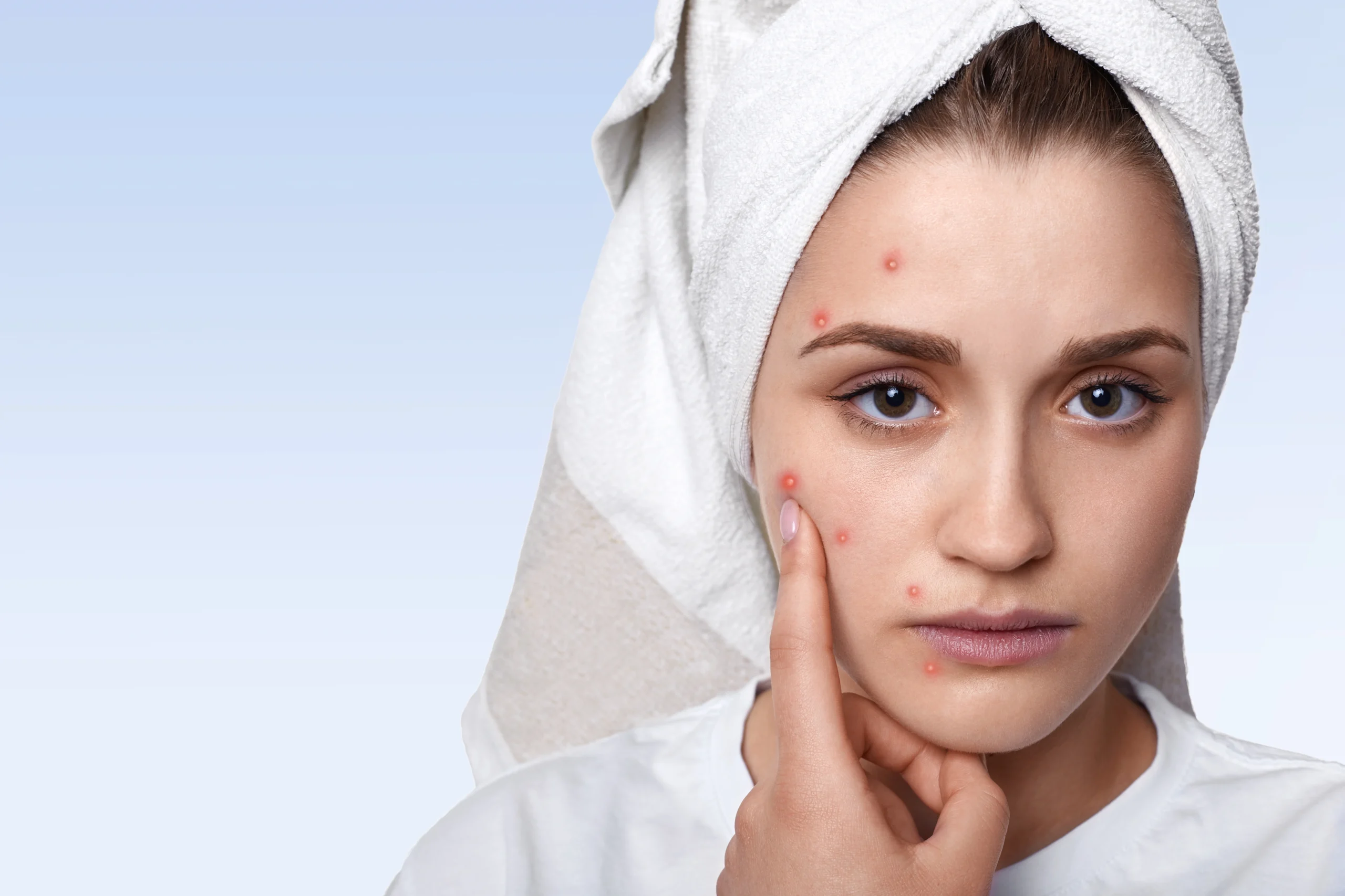 pimple , acne | Woman with towel on head pointing at pimples on her face.